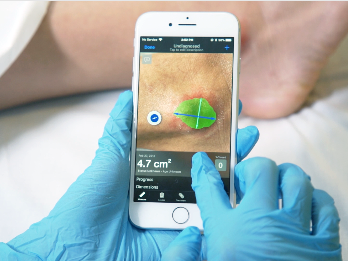 Swift's app measures a chronic wound on a patient, saying on the smartphone screen that it's 4.7 square centimeters