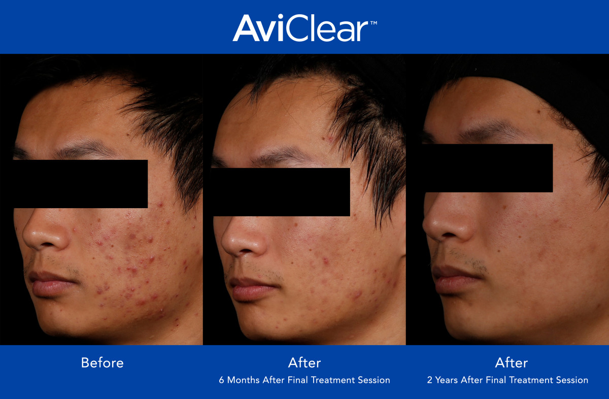 AviClear Review: This Is the Biggest Acne Breakthrough in Years