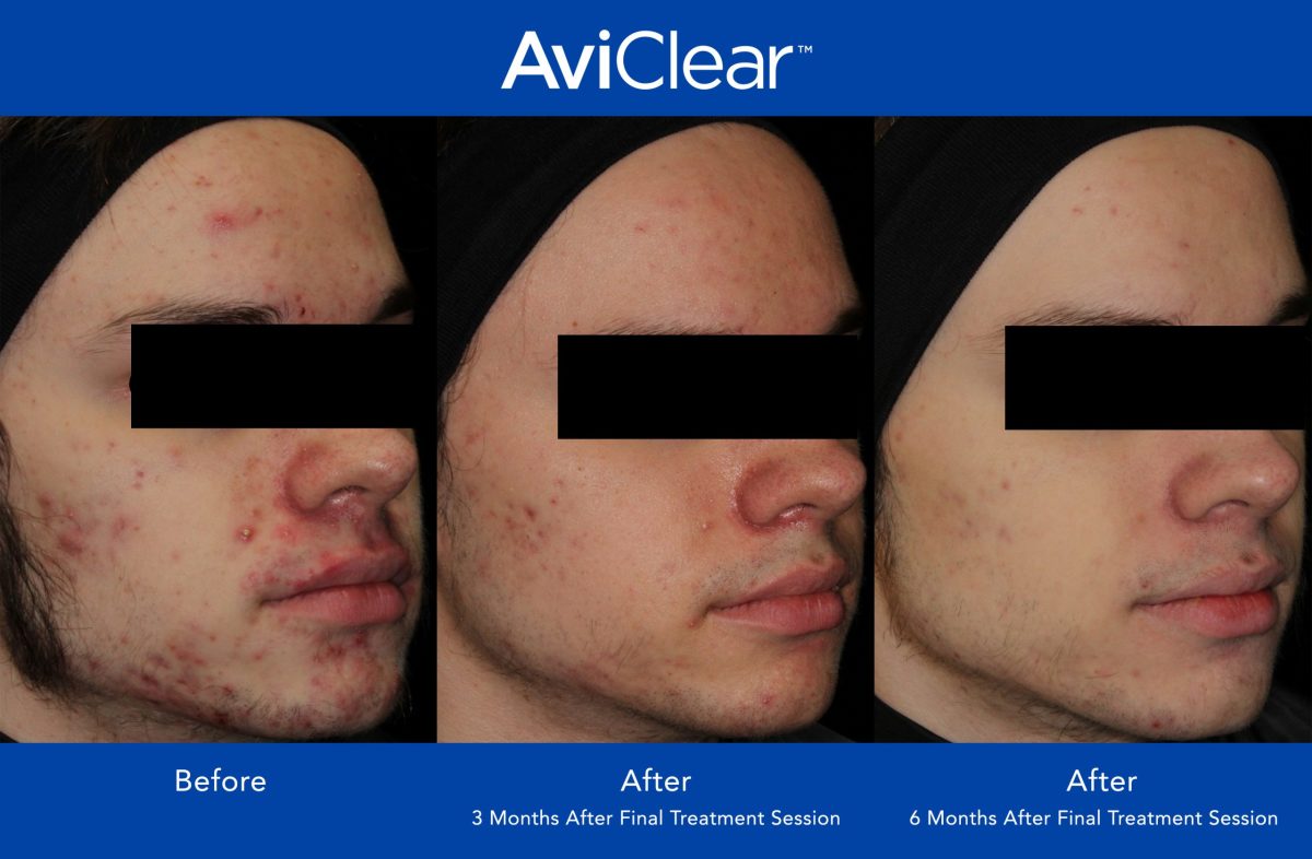 AviClear Review: This Is the Biggest Acne Breakthrough in Years
