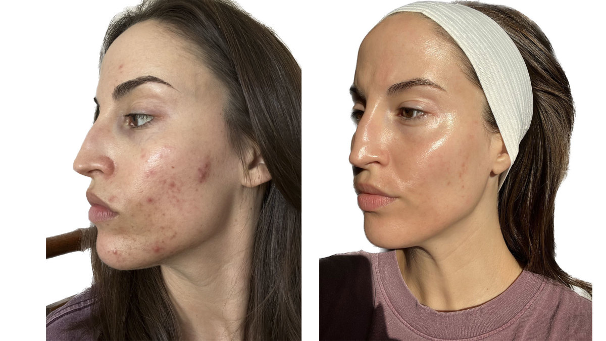 AviClear Review: This Is the Biggest Acne Breakthrough in Years